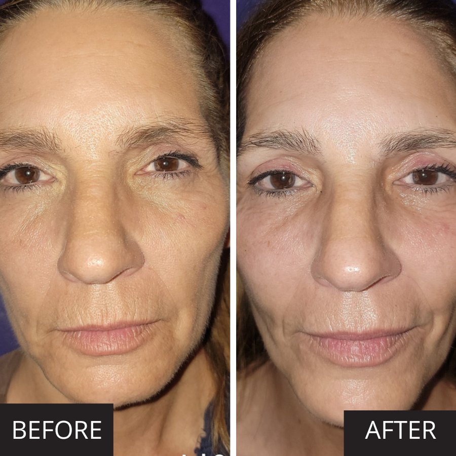 Myolift MD is a professional microcurrent machine for skincare 7E