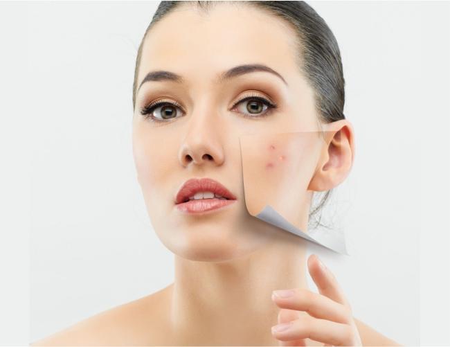 Unique ways of treating Acne - 7E Wellness