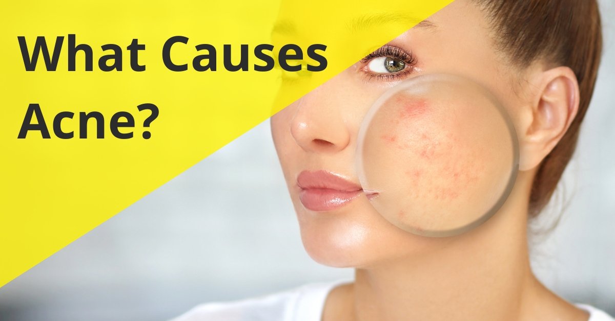 What Causes Acne? - 7E Wellness