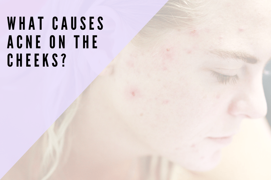 What Causes Acne on Cheeks? - 7E Wellness