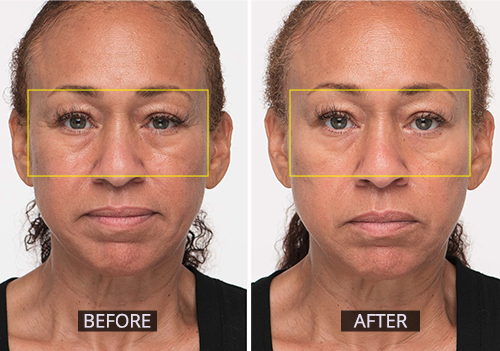 Lifting Facial - Edwards' Wellness & Skin Care