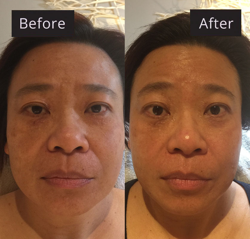 Microcurrent facial before and after results showing significant lifting.