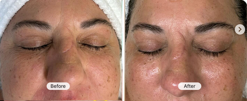 MyoLift™ Mini Firm and Bright Kit