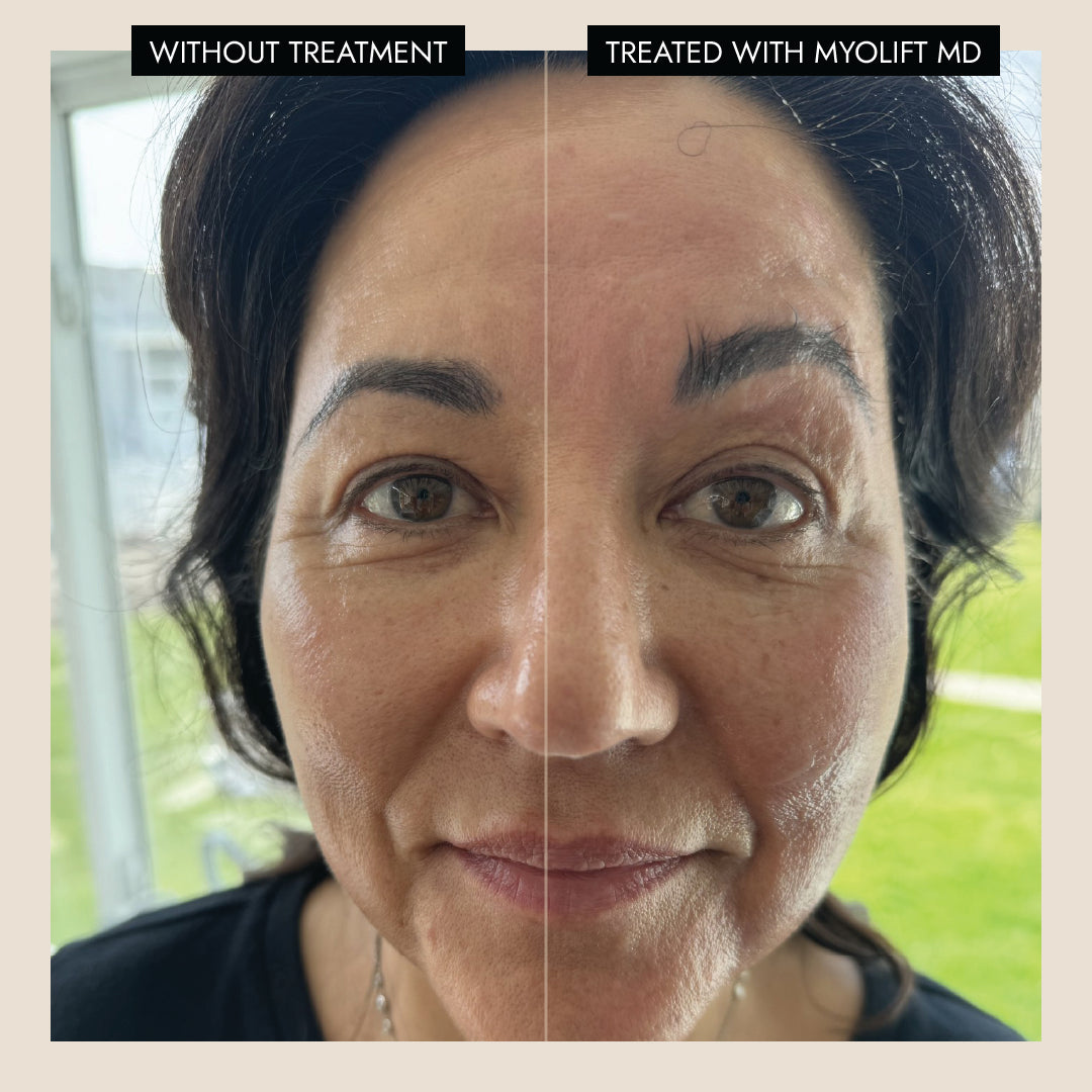 MyoLift™ MD