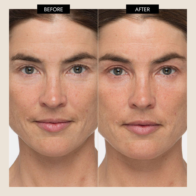 MyoLift_Triwave_before_after_clinical_result_photo
