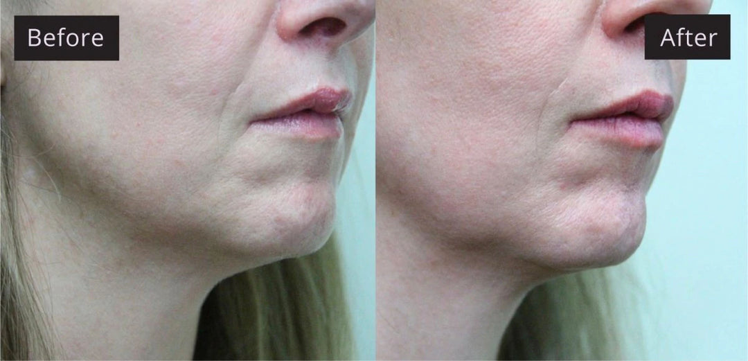 Microcurrent facial results showing before and after effects of a face lifting device.