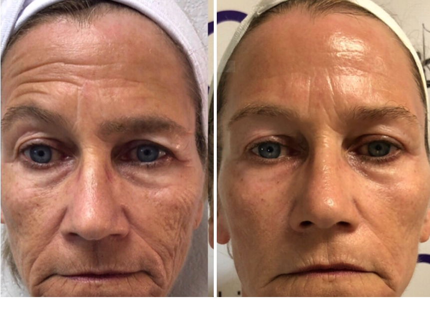 MyoLift™ 600+ With MyoLift Classic Kit