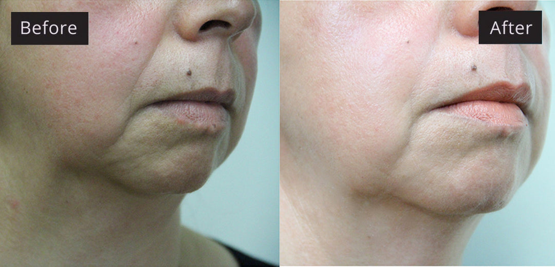 Results of microcurrent facial therapy with visible lifting effects.