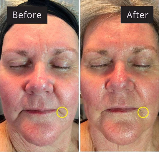 Katrina's results from using microcurrent therapy for facial lifting.