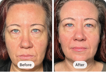 MyoLift™ Mini Wrinkle Reduction Kit