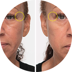 Showcasing the ability of our peptide serum to reduce wrinkle depth.