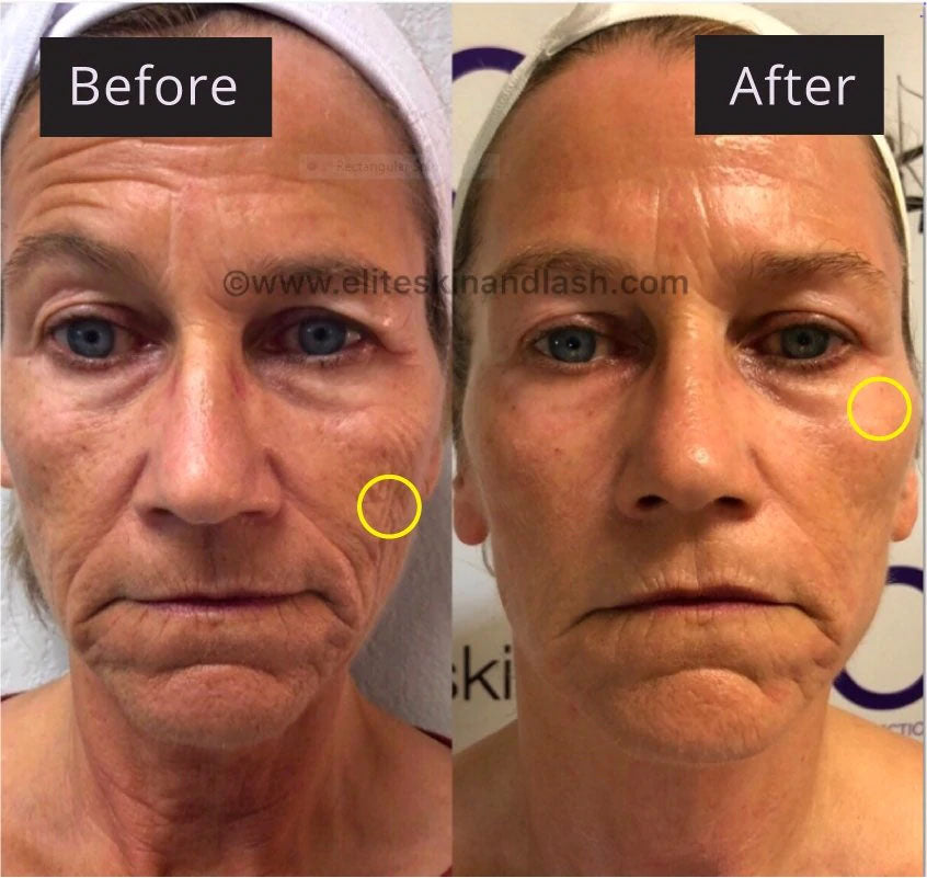 Results of microcurrent facial therapy highlighting significant lifting effects.