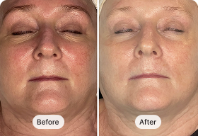 MyoLift™ Triwave Detox & Depuff Kit