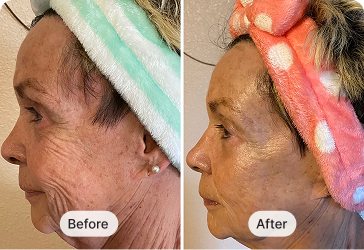 MyoLift™ 600+ With MyoLift Classic Kit