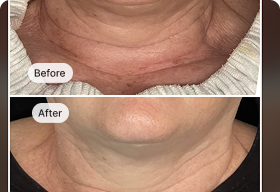 MyoLift™ Triwave Detox & Depuff Kit